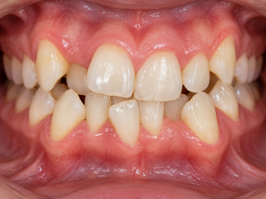 Braces – Dr. Sally Kalash